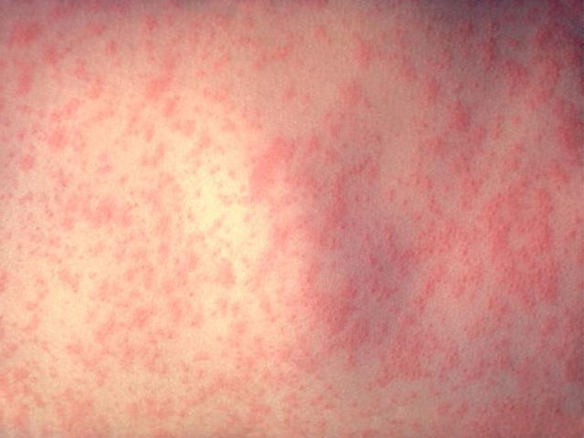 Measles alert issued for anyone who traveled through Chicago O'Hare airport