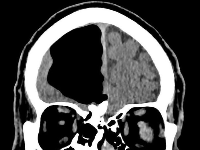 Doctors find air pocket hidden in man's brain