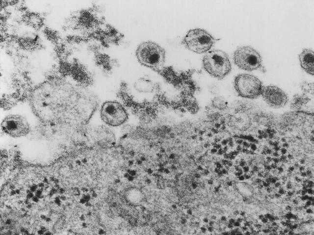 HIV rates rise in Wisconsin, Pennsylvania