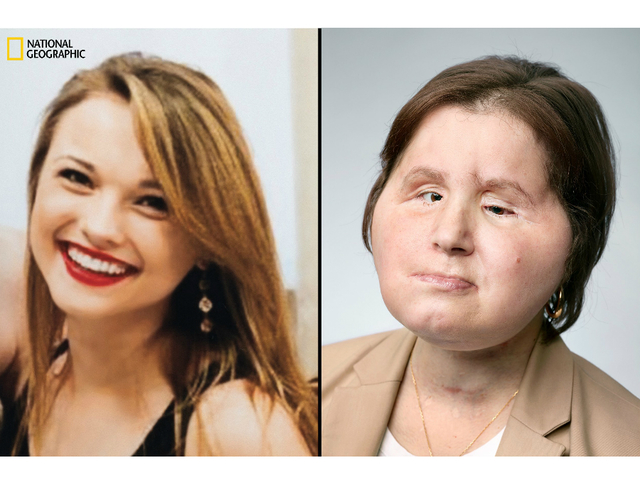 Face%20transplant_1534356914283.jpg_95006036_ver1.0_640_480 Katie Stubblefield