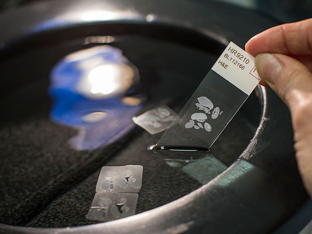 Tall people at greater risk of cancer, study says